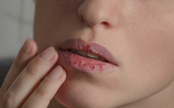 Humidifiers Need | Chapped Lips Image